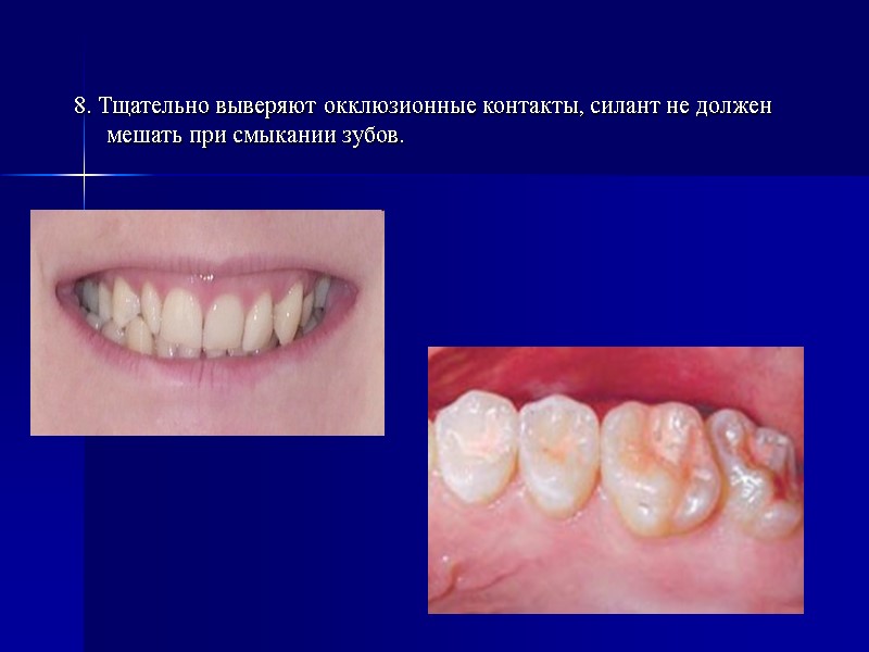 8. Тщательно выверяют окклюзионные контакты, силант не должен мешать при смыкании зубов.